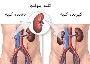 بیماری مزمن کلیه و درمان آن