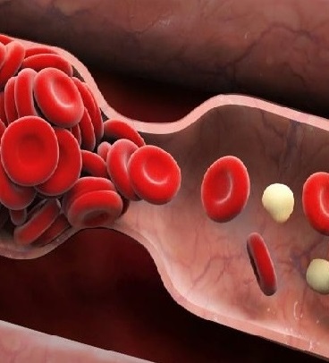 علائم وجود لخته خون در بدن