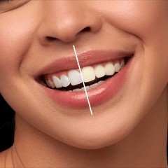 سفید کننده دندان مدل Vi-ONE